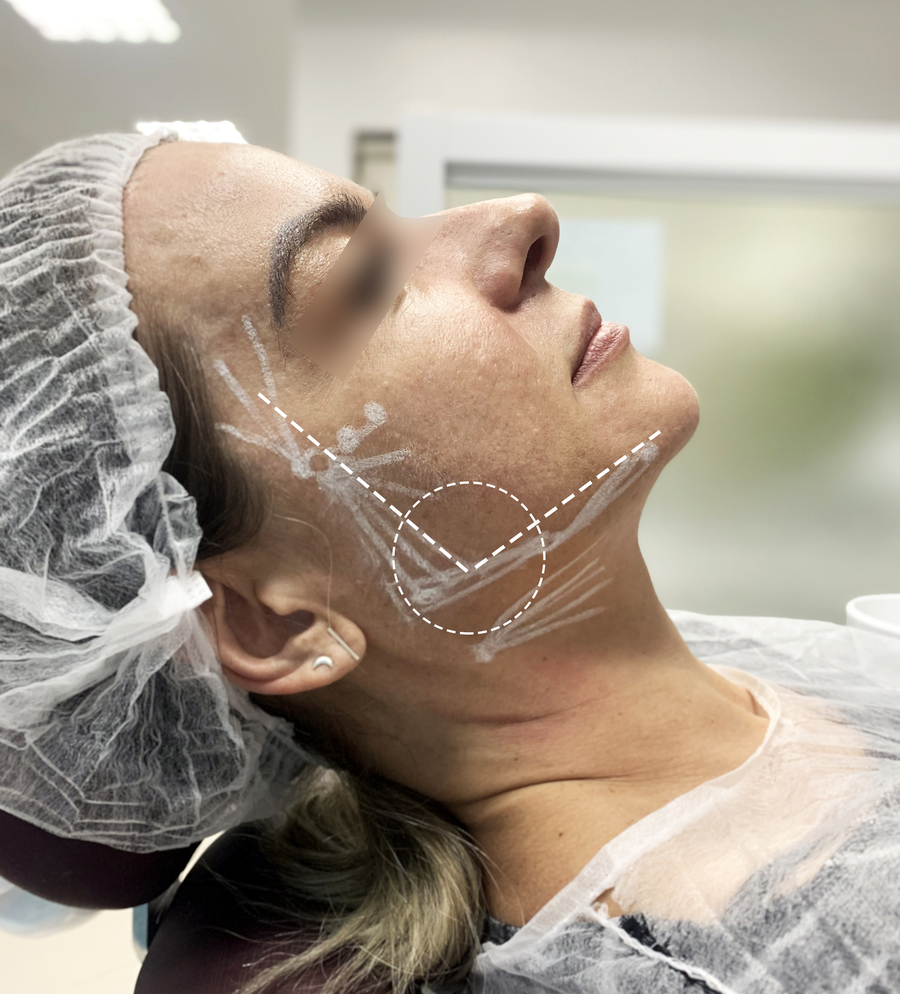 Entenda como funciona o procedimento de harmonização facial