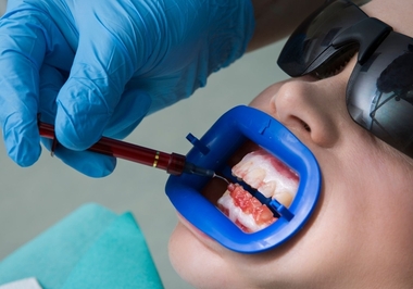 Clareamento dental: meus dentes ficarão sensíveis?