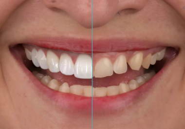 O que você precisa saber antes de colocar suas lentes de contato dental