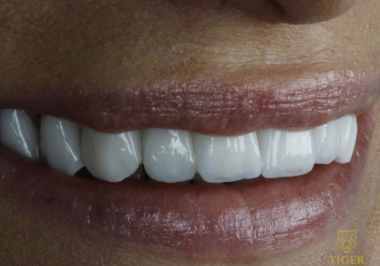 Qual é a diferença entre porcelana e lentes de contato dental?