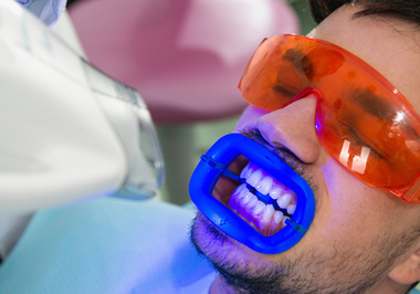 Tudo o que você precisa saber sobre clareamento dental