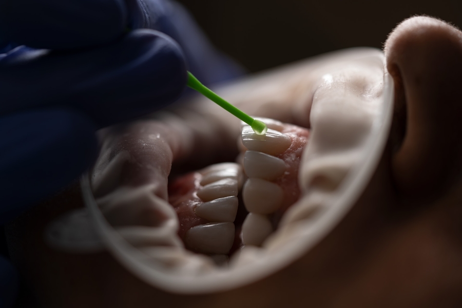 Descubra as Lentes de Contato Dentária e sua Revolução Estética