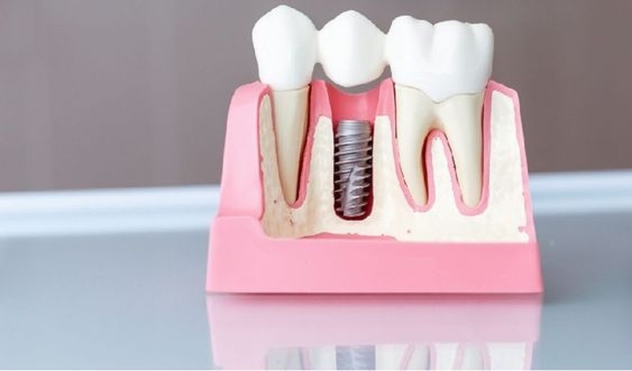 Enxerto Ósseo em Odontologia: Um Guia Completo para Entender e Cuidar da sua Saúde Bucal 