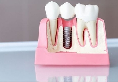 Enxerto Ósseo em Odontologia: Um Guia Completo para Entender e Cuidar da sua Saúde Bucal 