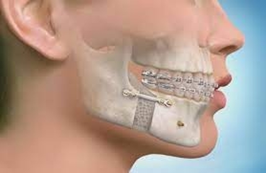.Revitalização Facial: O Fenômeno da Cirurgia Ortognática