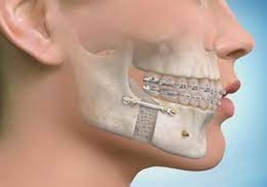 .Revitalização Facial: O Fenômeno da Cirurgia Ortognática