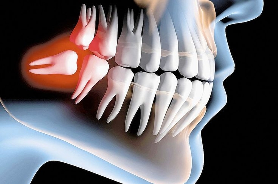 Por Que Deve-se Tirar o Siso? Descubra as Razões