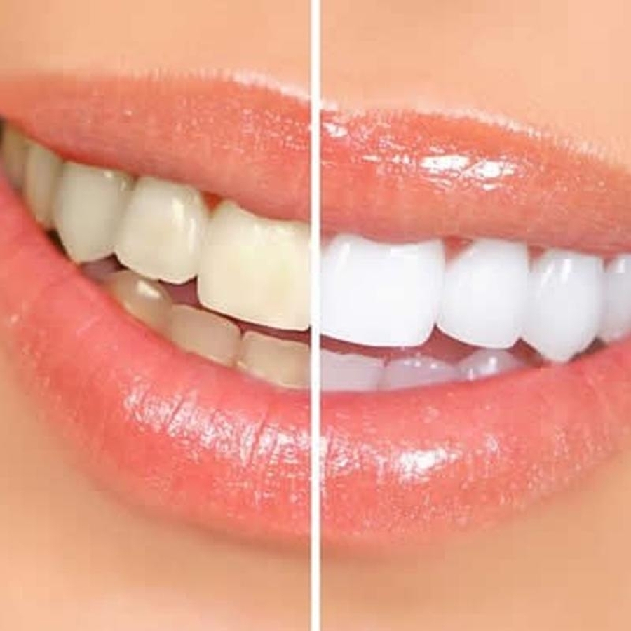 Desvendando o Mistério: Por Que os Dentes Ficam Amarelos?