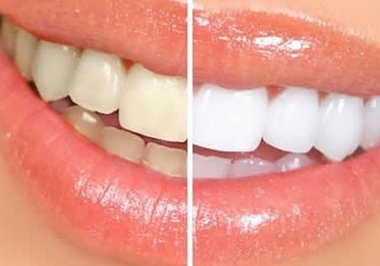 Desvendando o Mistério: Por Que os Dentes Ficam Amarelos?