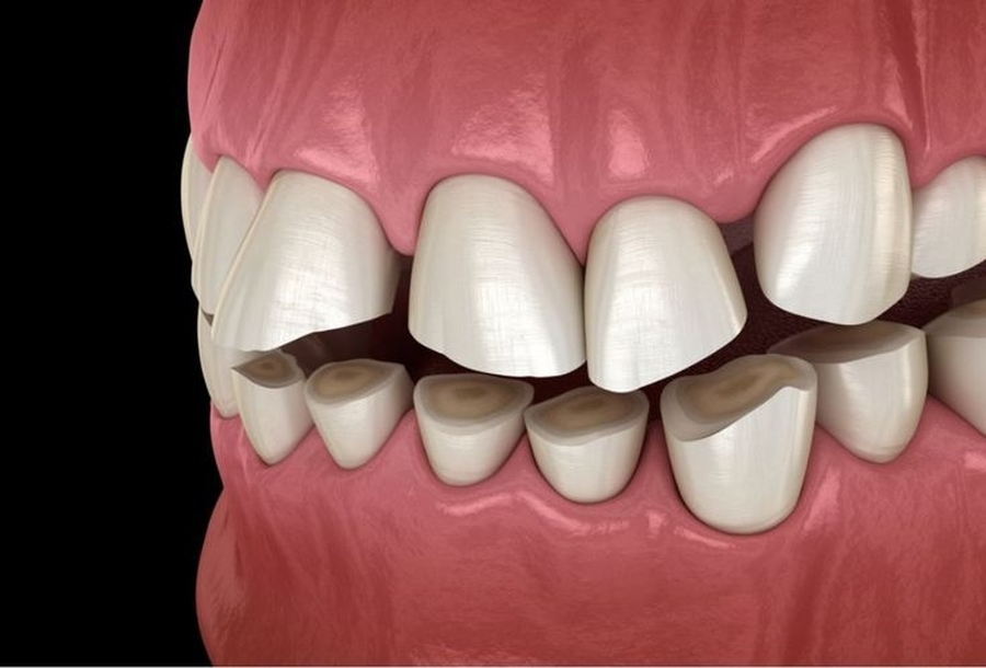 Bruxismo: a Maior Causa de Desgaste nos Dentes