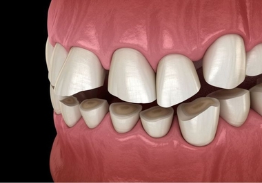 Bruxismo: a Maior Causa de Desgaste nos Dentes