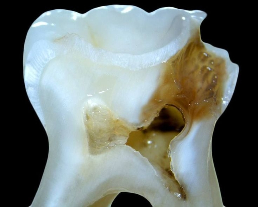 Tudo o Que Você Precisa Saber sobre Canal Dentário: Quando é Necessário?