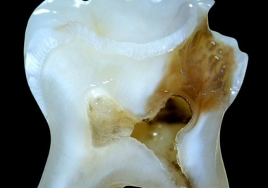 Tudo o Que Você Precisa Saber sobre Canal Dentário: Quando é Necessário?