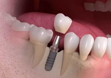 O Poder da Carga Imediata em Implantes Dentários
