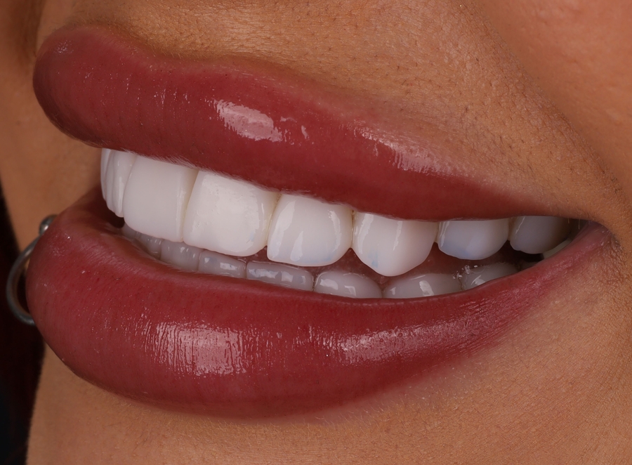 Lentes de Resina: Sorria com Confiança no Mesmo Dia