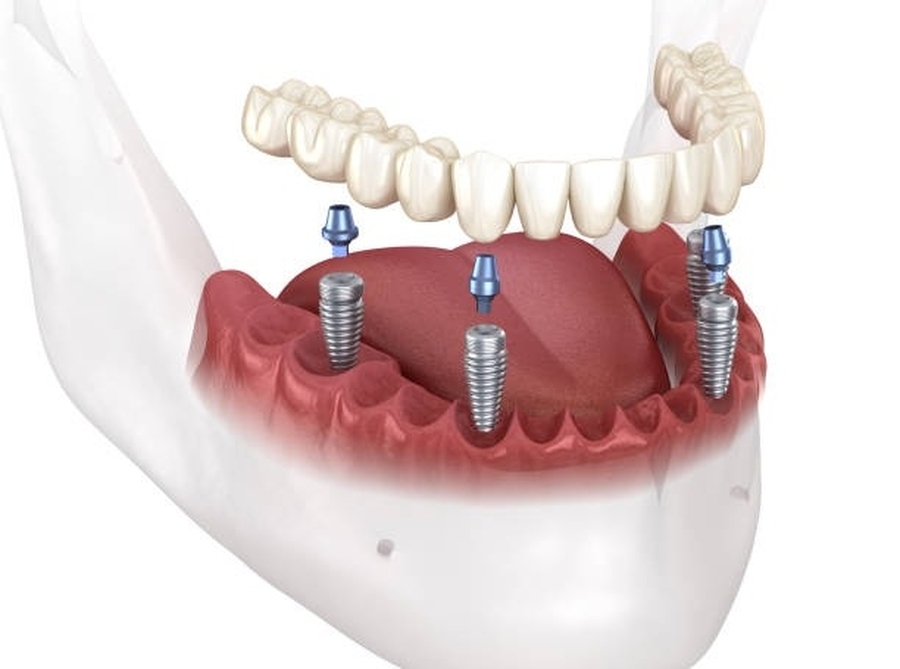 Recupere seu Sorriso com Rapidez: Os Benefícios da Carga Imediata