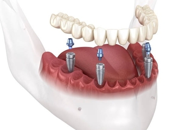 Recupere seu Sorriso com Rapidez: Os Benefícios da Carga Imediata