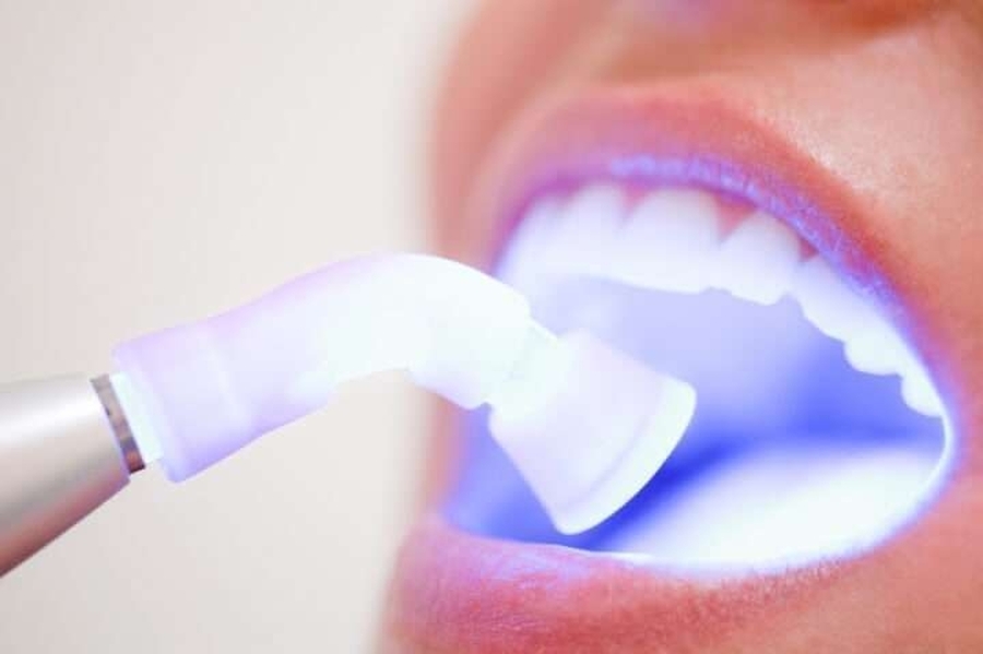 Clareamento Dental: Entenda o Tratamento que Ilumina Sorrisos 