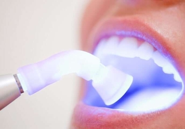 Clareamento Dental: Entenda o Tratamento que Ilumina Sorrisos 