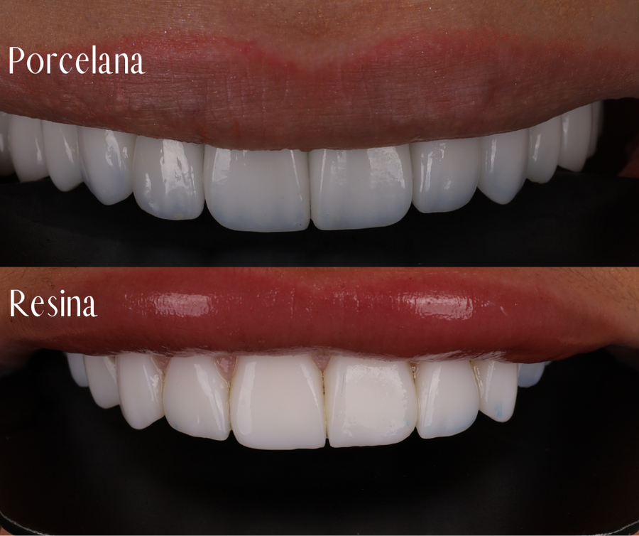 Lentes de Resina x Lentes de Porcelana: Qual é a Melhor Opção para o Seu Sorriso?