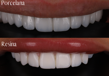 Lentes de Resina x Lentes de Porcelana: Qual é a Melhor Opção para o Seu Sorriso?