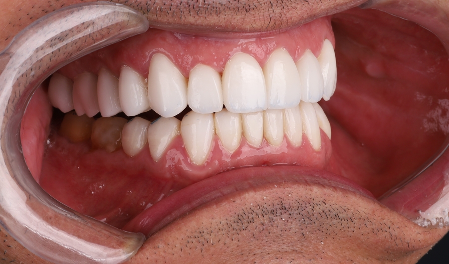 Gengiva Saudável, Sorriso Bonito: Por que o Cuidado Gengival é Essencial