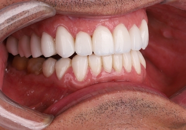 Gengiva Saudável, Sorriso Bonito: Por que o Cuidado Gengival é Essencial