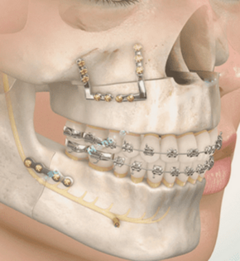 Cirurgia Bucomaxilofacial